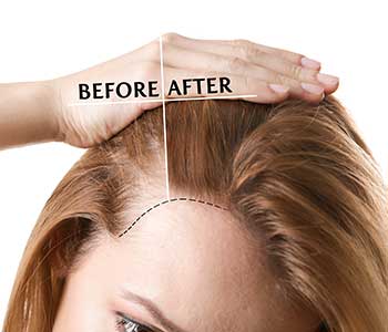 Halo Medispa PRP hair loss treatment for women